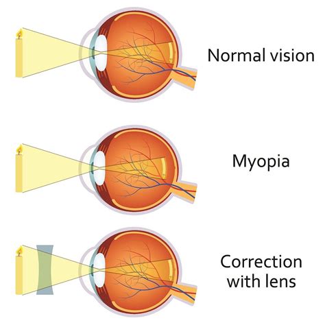 Myopia: Types, Causes, Symptoms & Treatment