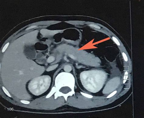 Cureus Ascaris Lumbricoides Infestation As An Unexpected Cause Of ...