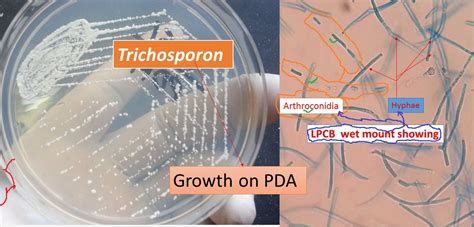 Trichosporon: Introduction,pathogenecity, lab diagnosis and treatment