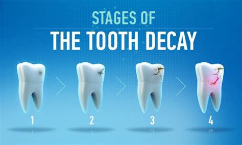 Cavity On Front Tooth and How to Fix It | IYTmed.com