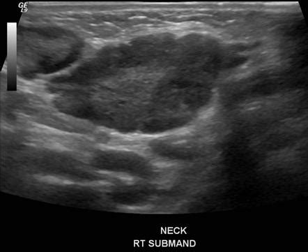 An Abnormal Lymph Node Demonstrates Which One of the Following