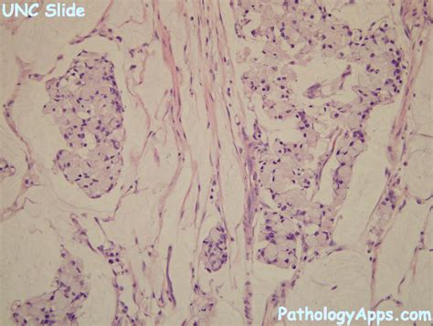 mucinous adenocarcinoma pathology