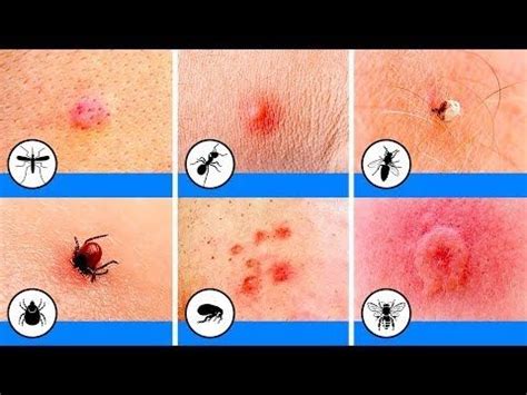 30 HD Pictures Of Oak Mite Bites On Humans - insectza