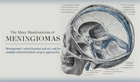 The Many Manifestations of Meningiomas | Pacific Neuroscience Institute