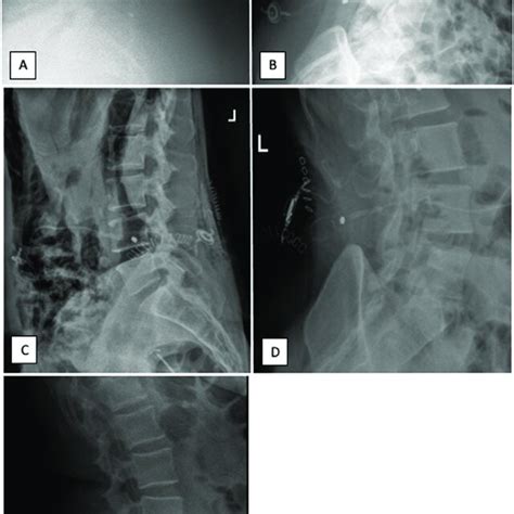 Lumbar radiographs of patients A to E, showing lumboperitoneal shunt ...