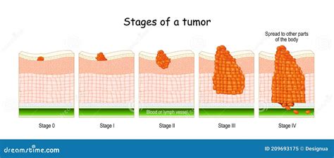 Stages Of Cancer. Classification Of Malignant Tumours Cartoon Vector ...