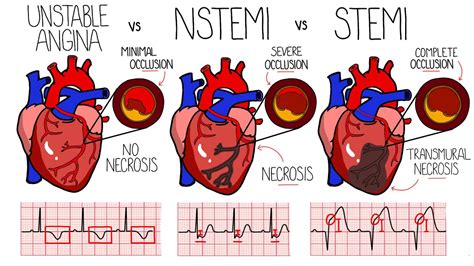 Acute Coronary Syndrome (Heart Attack) - Unstable Angina vs NSTEMI vs ...