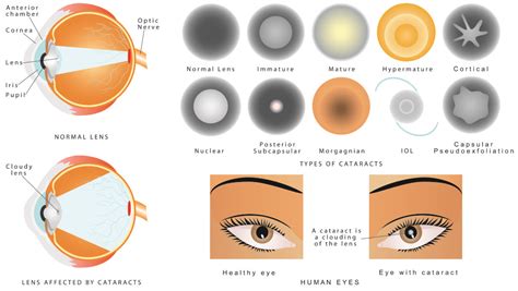 Cataract Surgery Honolulu HI - Clouded Lens Removal