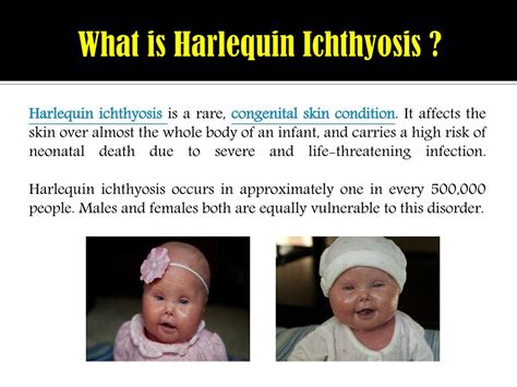 PPT - Harlequin Ichthyosis: Causes, symptoms, complications and ...