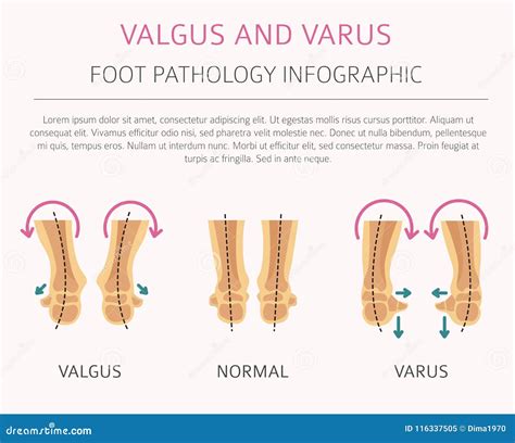 Deformación Del Pie Como Desease Médico Infographic Valgus Y Varu ...