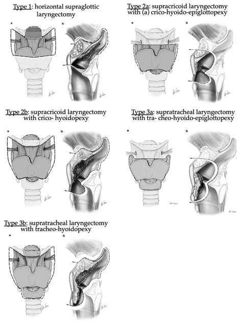 Supraglottic Laryngectomy