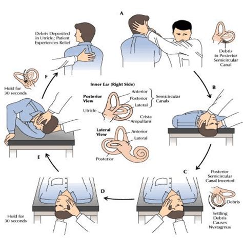 Bbq Roll Horizontal Bppv - My Bios