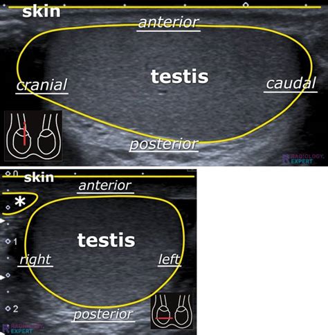 Scrotal ultrasound