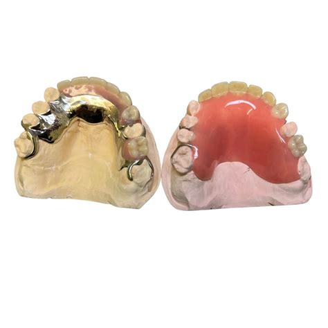 Chrome Partial Dentures Benefits