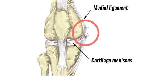 Inside knee pain Archives | Sports Injury Symptoms