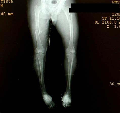 one leg shorter after femur fractures icd 10