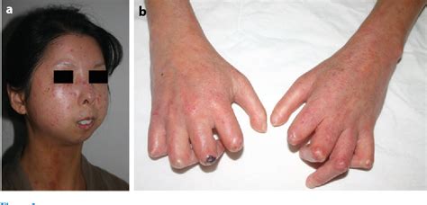 Figure 2 from The pathogenesis of systemic sclerosis. | Semantic Scholar