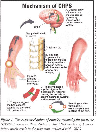 CRPS Guest Blog: Complex Regional Pain Syndrome - Capital Area PT ...