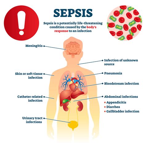 Sepsis: sudėtingas medicinos iššūkis. Kodėl? - Bonum.lt