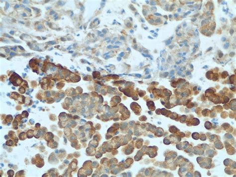 Primary goblet cell carcinoid tumor staining positive for... | Download ...