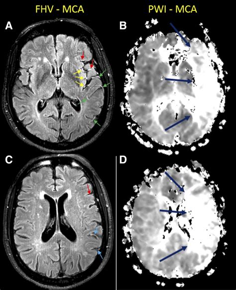 Estimating Perfusion Deficits in Acute Stroke Patients Without ...