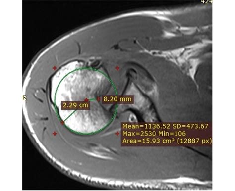 1st patient: MRI scan showing PSD, reverse Hill-Sachs lesion, impaction ...