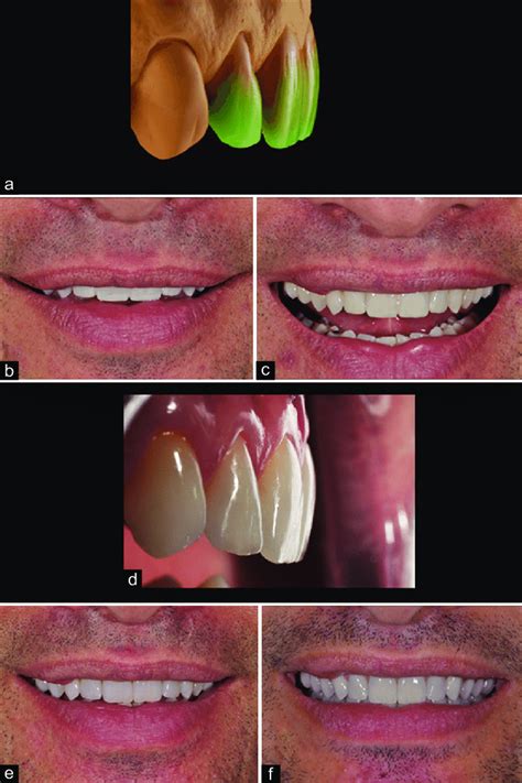 Diagnostic wax-up of teeth #7-10 (a) Front view of the mock-up with ...