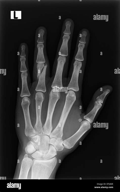 Fractured Finger X-Ray Stock Photo: 66781311 - Alamy