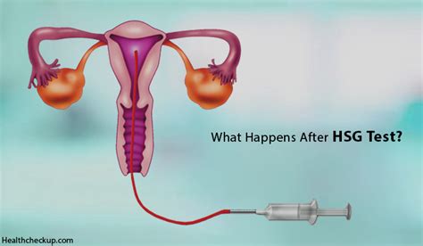 What Happens After HSG Test - Health Checkup