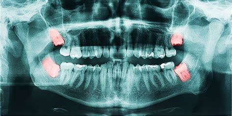 When Should Wisdom Teeth Be Removed?