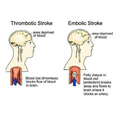 Stroke Risk Factors