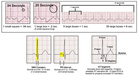 ECG (EKG) Interpretation - ACLS Wiki