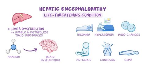 Medications for hepatic encephalopathy: Nursing pharmacology - Osmosis ...