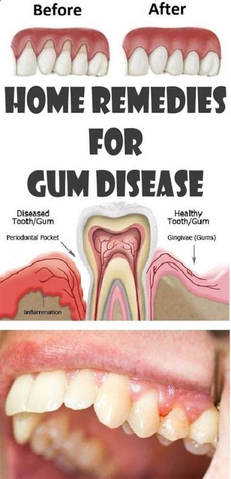 Home Remedies For Gum Infection In Dogs | Home and Garden Reference