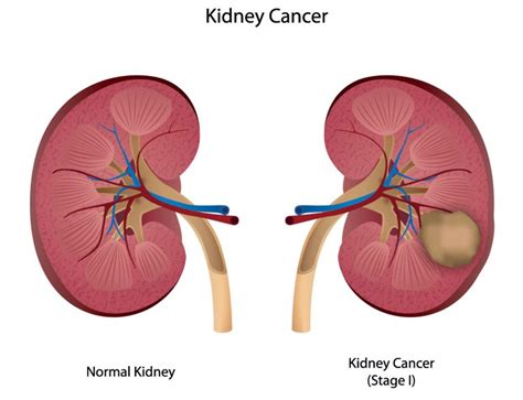 Kidney Cancer - DiseasesAndConditions.net