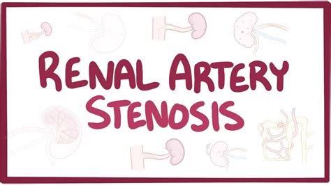 Renal artery stenosis - causes, symptoms, diagnosis, treatment ...