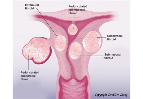 Uterine Fibroid Embolisation and Other Fibroid Treatments | Sydney ...