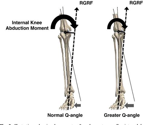 Figure 3 from Greater Q angle may not be a risk factor of ...