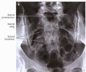 Sacrum Anatomy Xray