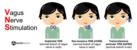 Vagus Nerve Stimulation Side Effects