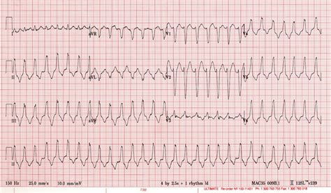 Supraventricular tachycardia (SVT). Causes, symptoms, treatment ...