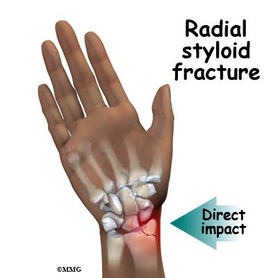 Adult Wrist Fractures - Midwest Bone and Joint Institute - Illinois