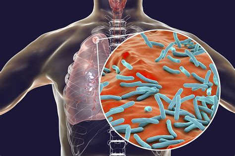 Tuberculosis Symptoms - Causes, Diagnosis & Treatment | Max Lab