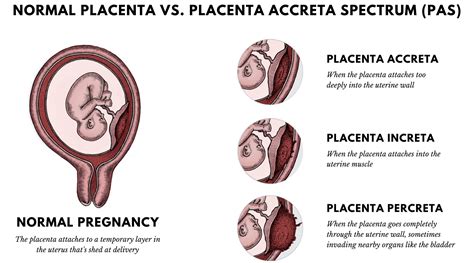 Placental Problems During Pregnancy And Management - HealthPally.com