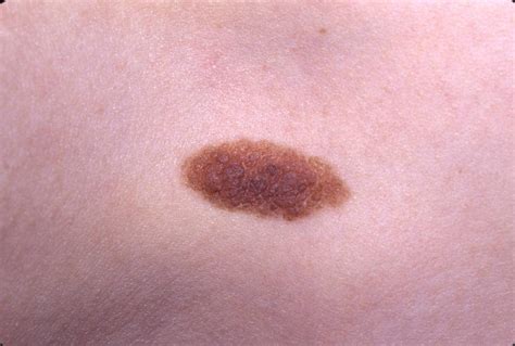 Common Birthmarks - The Clinical Advisor