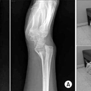 (PDF) Complications of Distal Radius Fracture