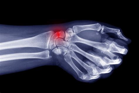 Broken Wrist Treatment at Orthotics Plus - Melbourne