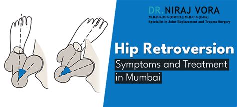 Hip Retroversion Symptoms and Treatment in Mumbai