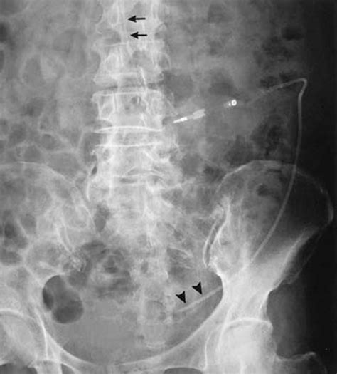 Endoscopically aided retroperitoneal placement of a lumboperitoneal ...