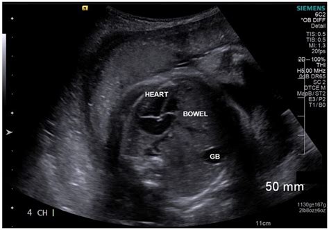 Fetal Umbilical Hernia Ultrasound – NBKomputer